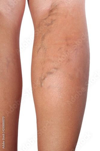 Close up of varicose veins