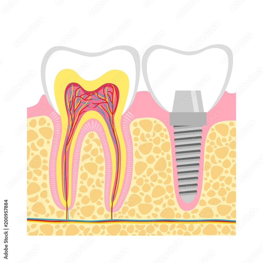 Human teeth and Dental implant Vector Illustration Human teeth and Dental implant Vector Illustration