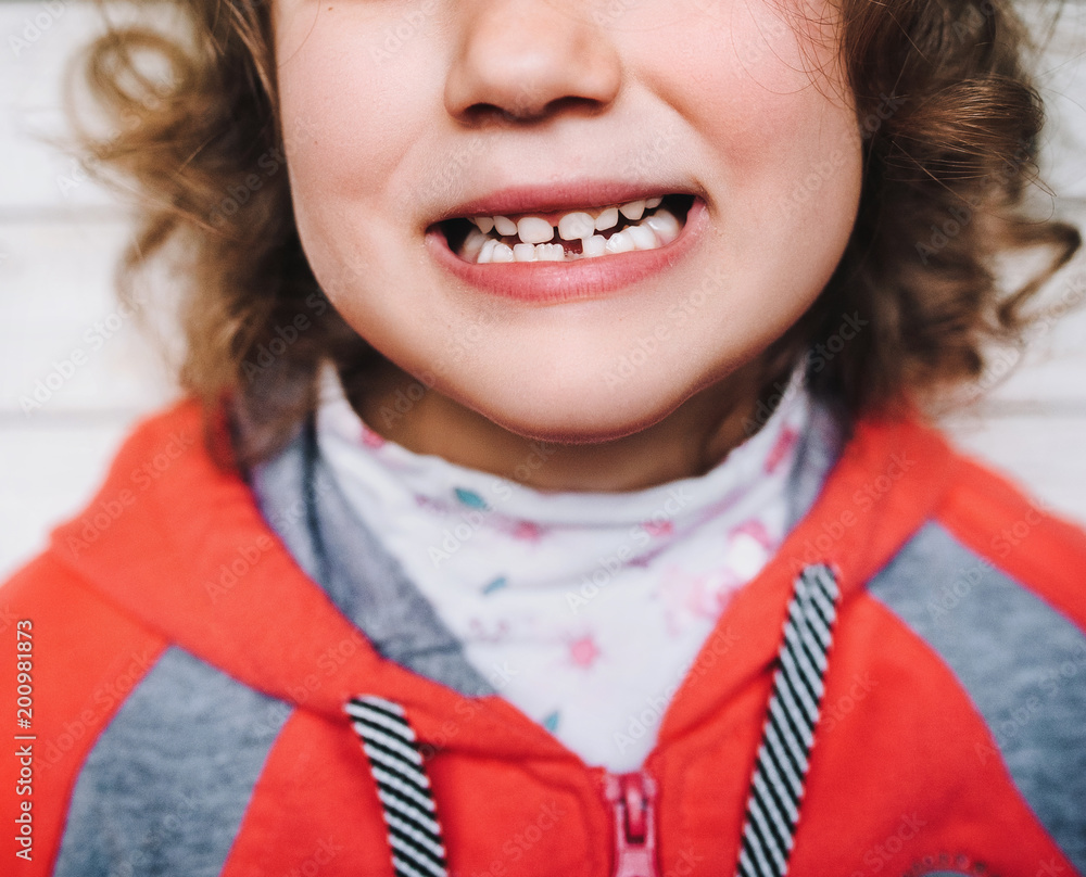 Baby smile with baby teeth. Loss of teeth. The front tooth fell out