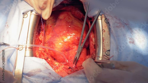 Surgeons are sewing up human heart while operating it photo