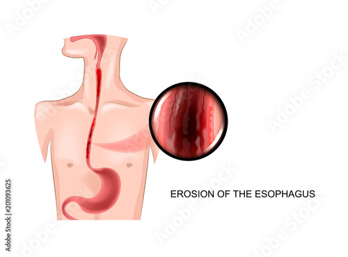 erosion of the esophagus photo