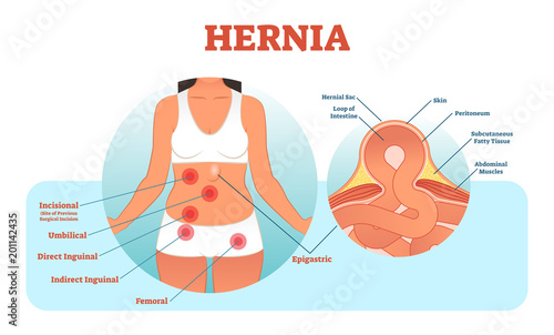 Hernia types vector illustration and cross section of muscle rupture and intestine.