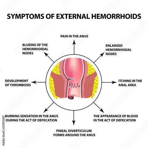 Symptoms of external hemorrhoids. The hemorrhoidal node in the rectum, anus. Infographics. Vector illustration on isolated background.