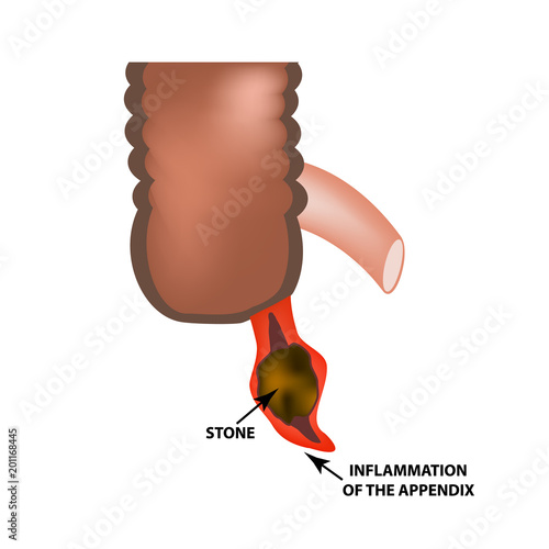 Inflammation of the appendix. Appendicitis. Gemstone. Infographics. Vector illustration on isolated background.