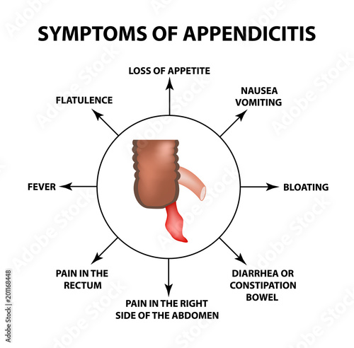 Symptoms of appendicitis. Inflammation of the appendix. Infographics. Vector illustration on isolated background.