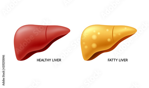 Comparison of healthy liver and fatty live. Liver Disease. Illustration info-graphic, isolated on white background.