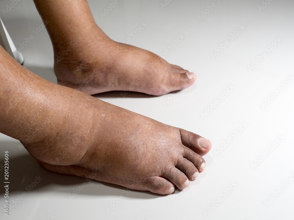 Fototapeta premium The feet of people with diabetes, dull and swollen. Due to the toxicity of diabetes placed on a white background.