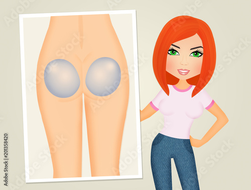 Fototapeta kuchenna implants in the buttocks