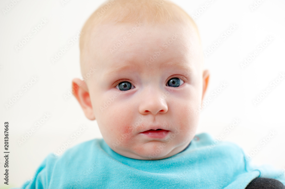 Allergies, atopic dermatitis on the face of a baby Allergies, atopic dermatitis on the face of a baby