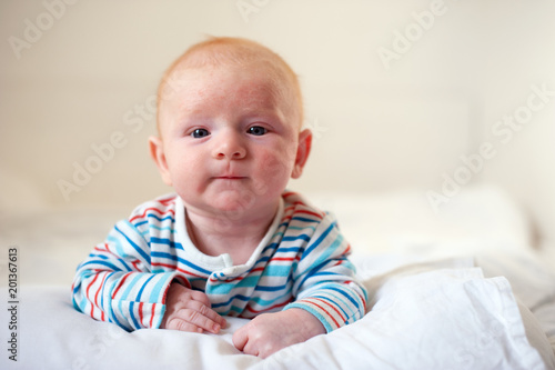 Allergies, atopic dermatitis on the face of a baby