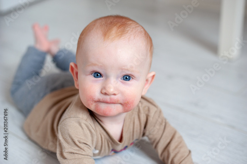 Allergies, flaking and wounds, atopic dermatitis on the face of a baby photo