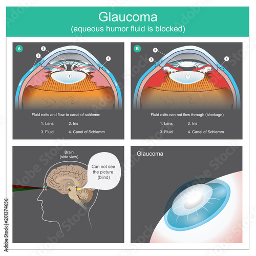 Glaucoma. Aqueous humour fluid exits and flow to canal of schlemm human eyes. Illustration.