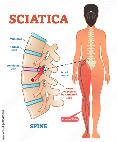 Sciatica medical health care vector illustration diagram scheme with lower spine and sciatic nerve pain in leg.