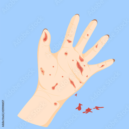 Wounded hand