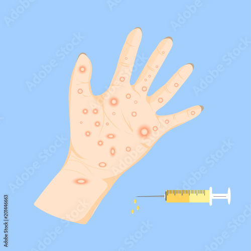 Chicken pox on hand