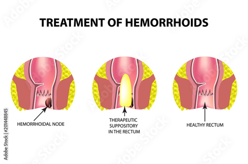 Treatment of hemorrhoids with suppositories. Infographics. Vector illustration on isolated background.