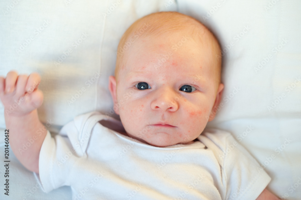 Allergies, atopic dermatitis on the face of a baby Allergies, atopic dermatitis on the face of a baby