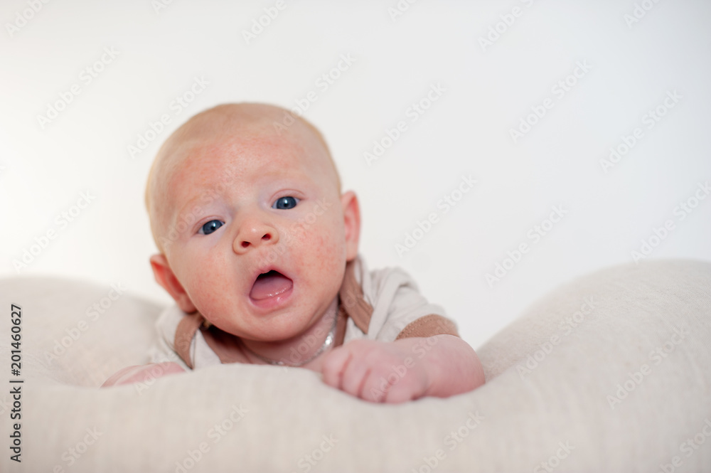 Allergies, atopic dermatitis on the face of a baby Allergies, atopic dermatitis on the face of a baby