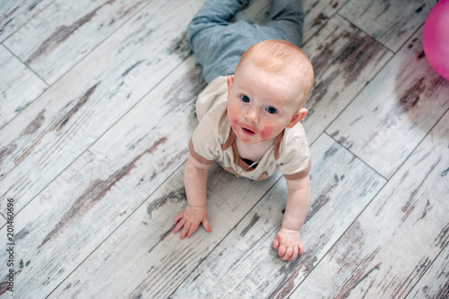 Allergies, atopic dermatitis on the face of a baby