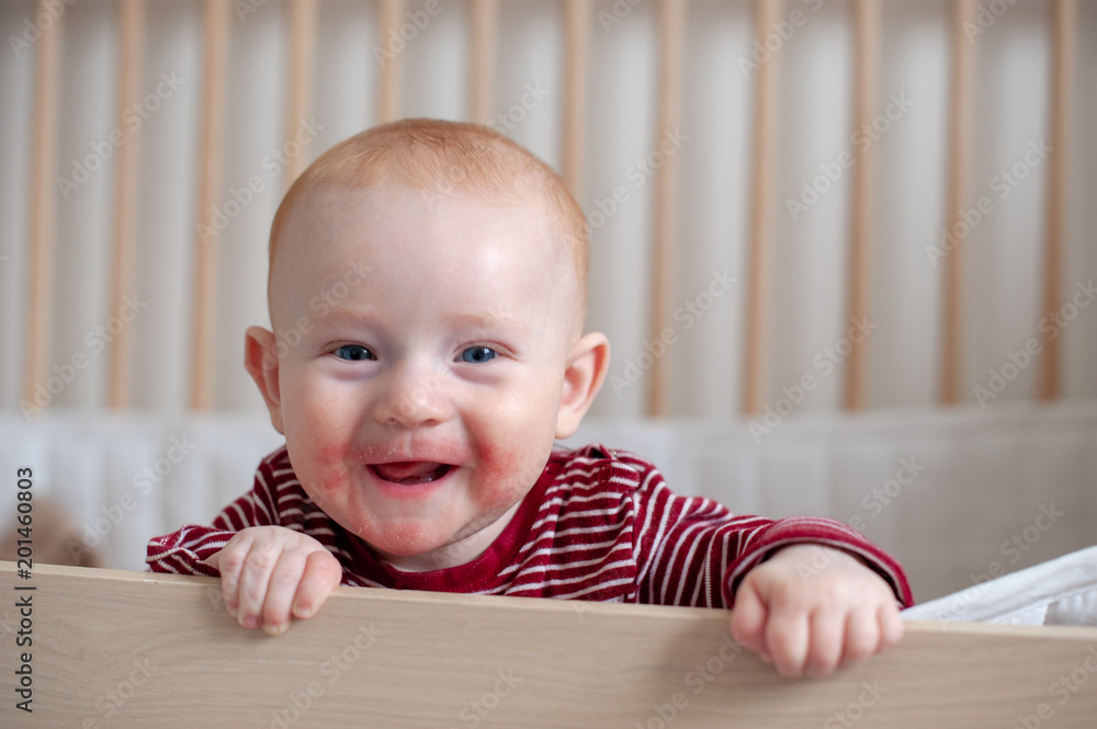 Allergies, atopic dermatitis on the face of a baby Allergies, atopic dermatitis on the face of a baby