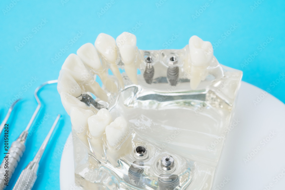 implant and orthodontic model for student to learning teaching model showing teeth. implant and orthodontic model for student to learning teaching model showing teeth.