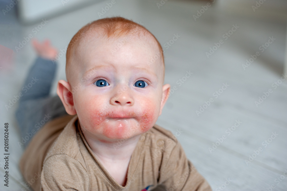 Traces of diathesis, allergies on baby's cheeks