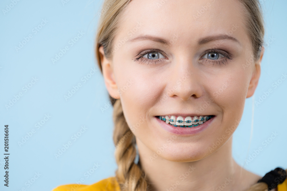 Woman showing her teeth with braces Woman showing her teeth with braces