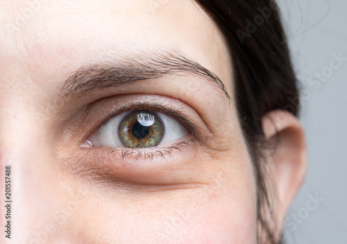 Macro image of woman puffy eye, female with eye bags