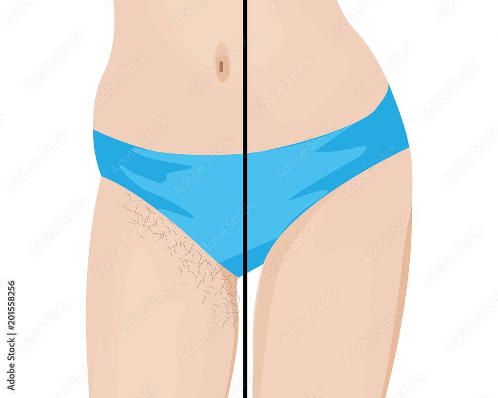 Hair removal results. Before and after. vector illustration Hair removal results. Before and after. vector illustration