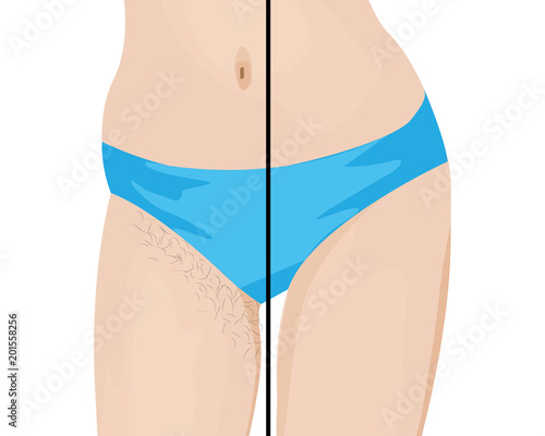 Hair removal results. Before and after. vector illustration