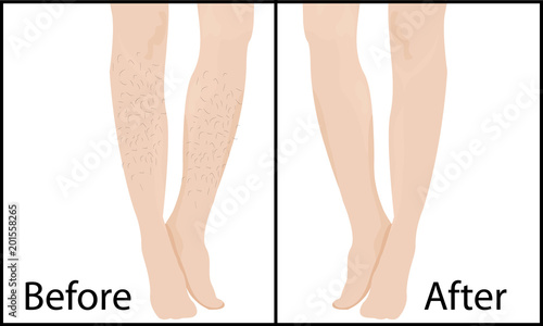 Before and after Hair removal methods and results vector illustration