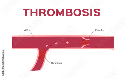 thrombosis in blood vein vector / organ and anatomy concept / Pulmonary Embolism