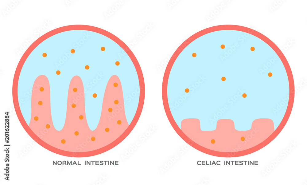 Celiac disease Small intestine lining damage. good and damaged villi ...