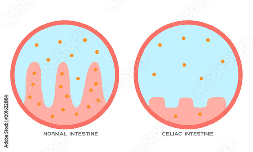 Celiac disease Small intestine lining damage. good and damaged villi . leaky gut progression