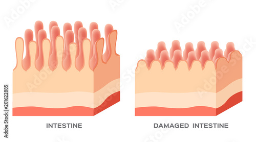 Celiac disease Small intestine lining damage. good and damaged villi . leaky gut progression