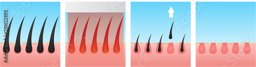 hair laser removal vector