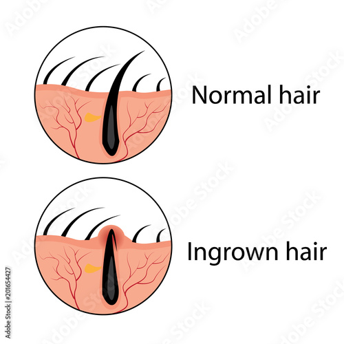 Normal and ingrown hair vector illustration
