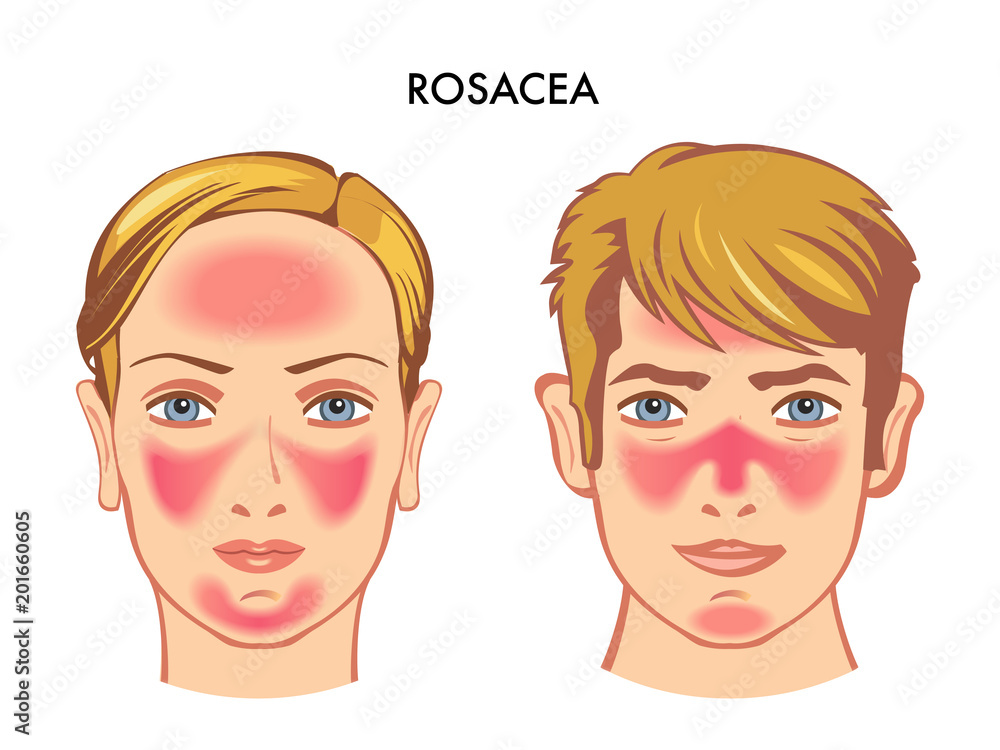 vector medical illustration of the symptoms of skin disease called rosacea vector medical illustration of the symptoms of skin disease called rosacea