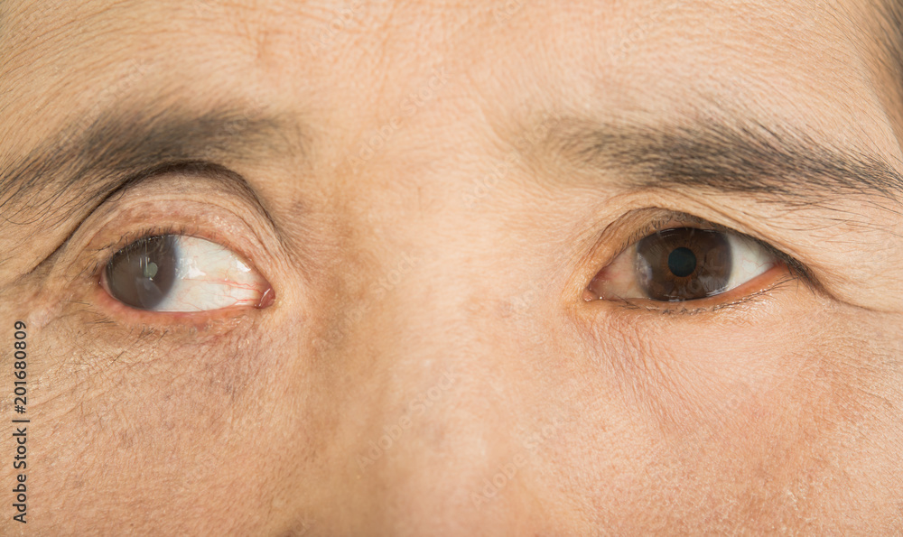 Fototapeta premium Abnormalities in the eyes