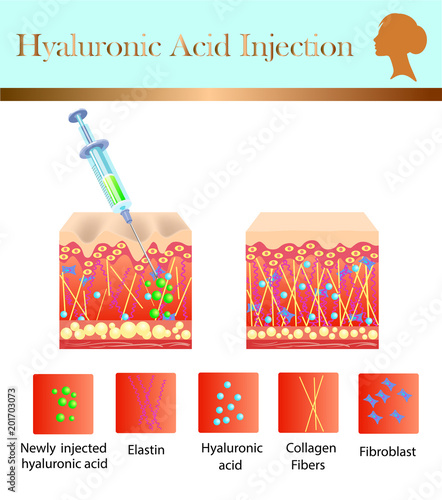 hyaluronic acid injection, before and affect , vector illustration