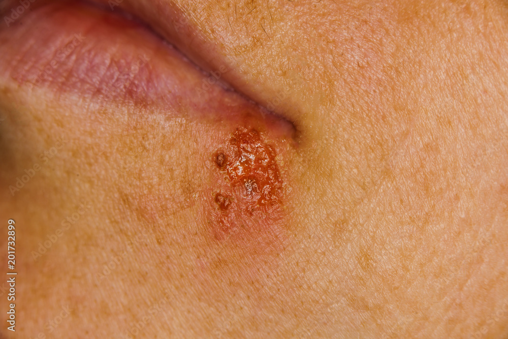 herpes on the lip of a person herpes on the lip of a person