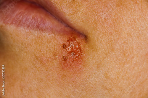 herpes on the lip of a person