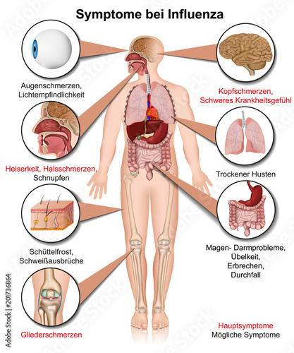 Symptome bei Influenza - Grippevirus, Krankheitsbild
