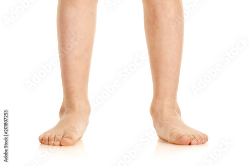Closeup of naked little boy with valgus deformity of legs © Denys Kurbatov