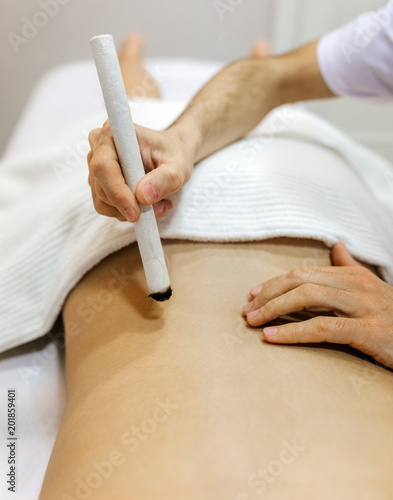 Woman being treated with acupuncture and moxibustion treatments