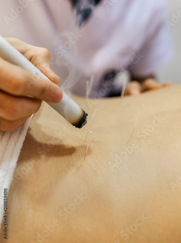 Canvas Print Woman being treated with acupuncture and moxibustion treatments