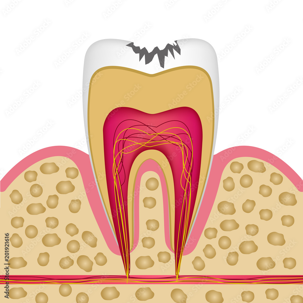 Tooth structure in cross section with caries to use on posters, booklets, leaflets, website.