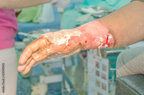 Dressing burned wound
