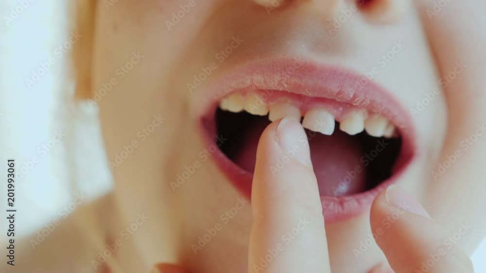 The baby's tooth is ready to fall out The baby's tooth is ready to fall out