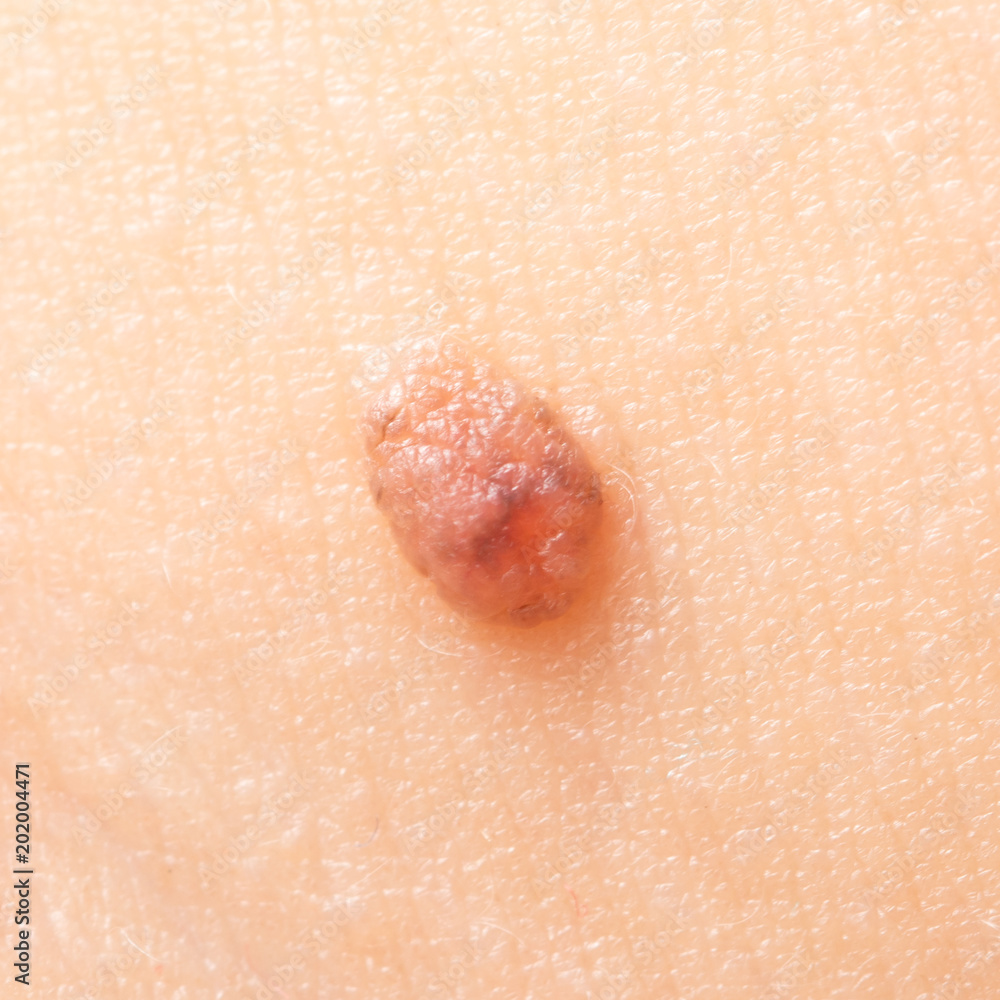 Fototapeta premium Birthmark on the skin as a background